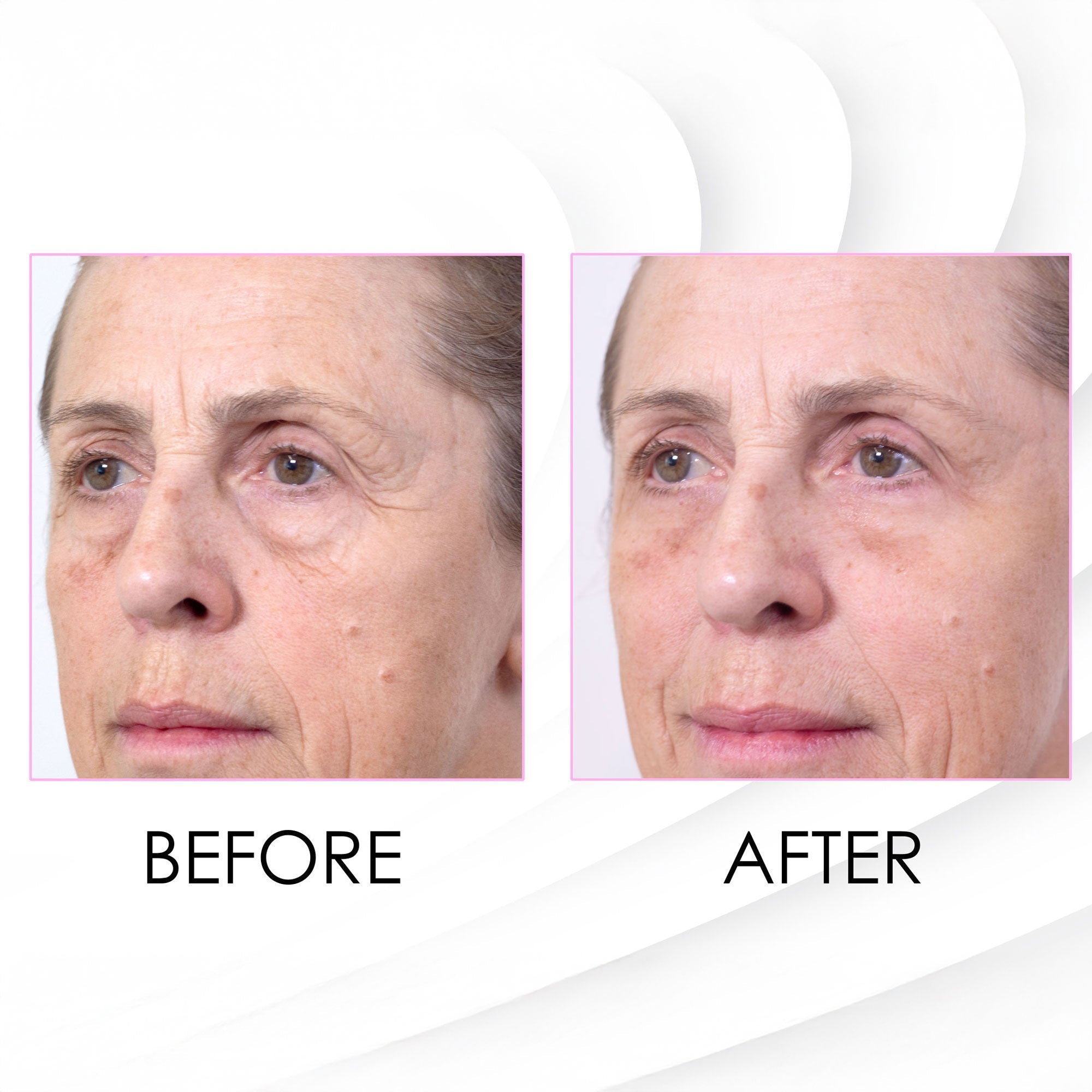 Wrinkle Killer Instant Face Lift 5 x 2ml